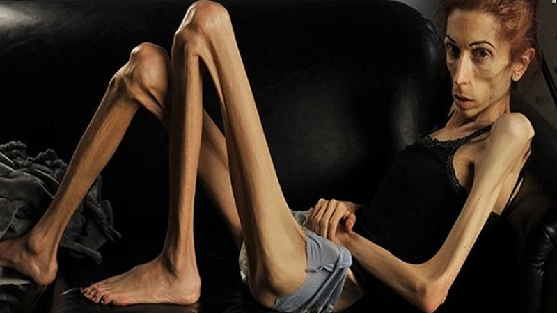 Nguyên nhân chứng biếng ăn ở người lớn và cách điều trị 5 Nguyên nhân chứng biếng ăn ở người lớn và cách điều trị