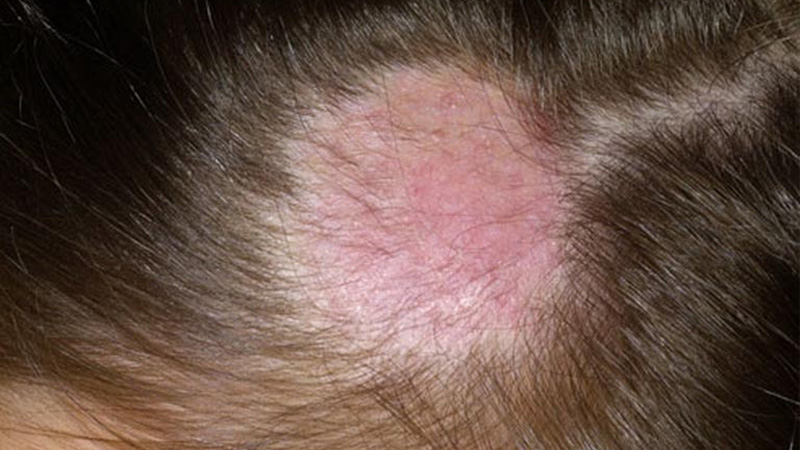 Nguyên nhân rụng tóc ở trẻ em dưới 10 tuổi và cách điều trị