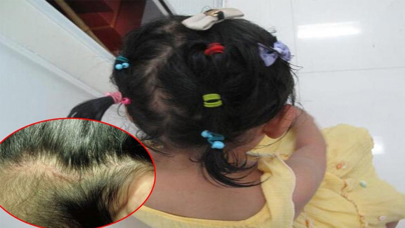 Nguyên nhân rụng tóc ở trẻ em dưới 10 tuổi và cách điều trị