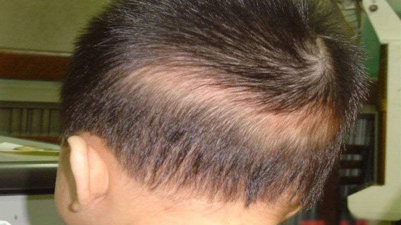 nguyen nhan rung toc o tre em 10 tuoi 5