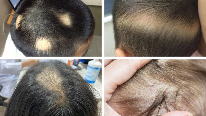 Nguyên nhân rụng tóc ở trẻ em dưới 10 tuổi và cách điều trị
