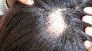 rung toc tung mang co moc lai duoc khong